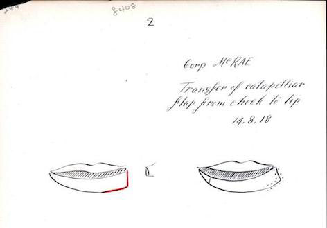 Gillies British Patient File of Corporal W McRae